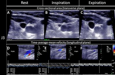 Transient Global Amnesia Linked to Impairment of Brain Venous Drainage: An Ultrasound Investigation